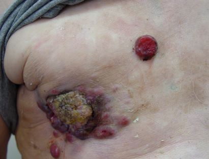 Рак кожи &mdash; симптомы, прогноз, лечение, диагноз